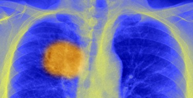 Британские ученые заявили о прорыве в лечении рака