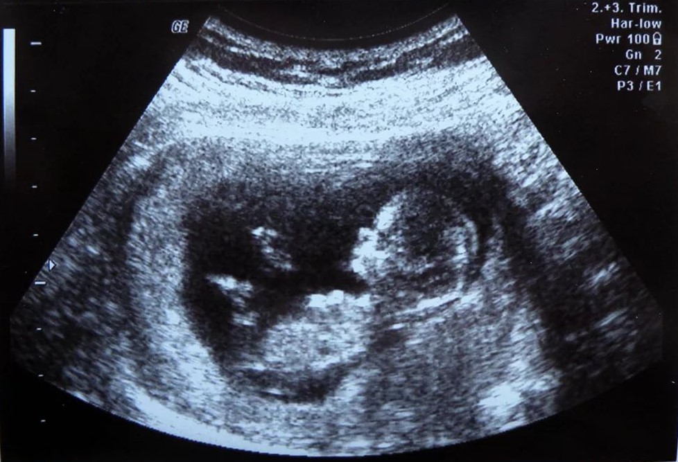 РПЦ предложила законодательно запретить врачам предлагать беременным аборты